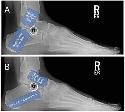 Pediatric Flatfeet—A Disease Entity That Demands Greater Attention and Treatment